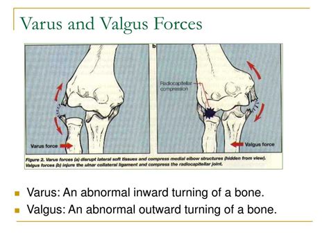 valgus vs varus force elbow